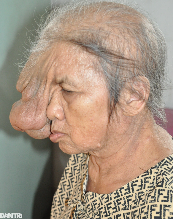 Xót xa người phụ nữ có gương mặt quái dị vì mang khối u to như một chiếc đầu người  - Ảnh 2